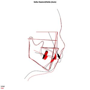 骨格性上顎前突OJ12mm