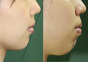 バイマックスでの本当の矯正治療によるくちもとの変化