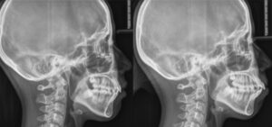 矯正歯科医によるバイマックスの治療前後