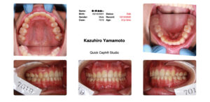 きりりと凛々しい口元に/抜歯を視野に入れたワイヤーによる矯正治療結果