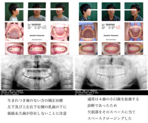 生まれつき部分的に歯のない方の矯正治療