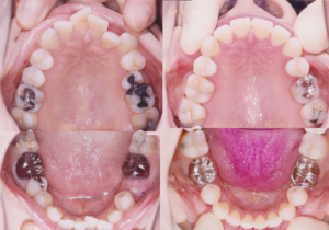 デコボコした歯列の矯正歯科専門医による治療結果