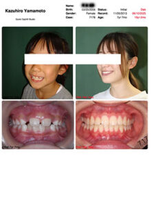 非抜歯顎顔面整形治療症例2