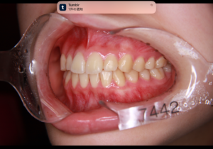 Pat.NHカマクラデントフェイシャルオーソピディクス・山本歯科・矯正長期安定症例 