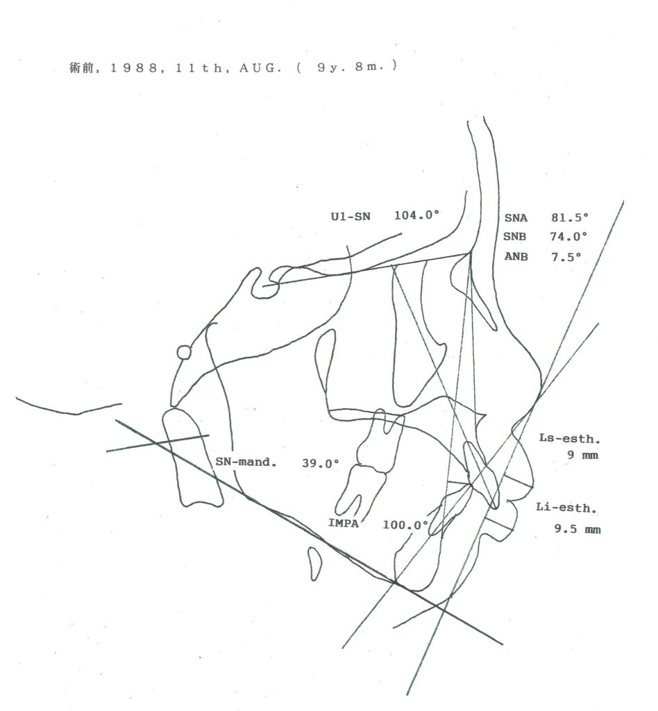 カマクラデントフェイシャルオーソピディクス創案の取り外しが効くマウスピース型矯正装置ミニマムアクチベータ治療症例術前のセファロ分析