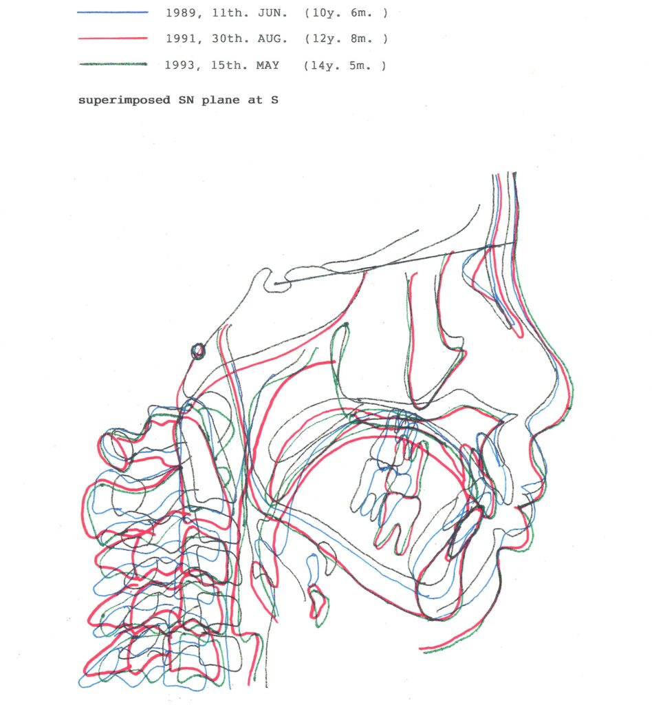 日本歯科専門医機構認定矯正歯科専門医山本一宏創案によるミニマムアクチベータおよびエッジワイズ装置による矯正治療結果