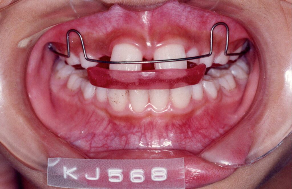 当院で創案・発展した出っ歯矯正用取り外し可能装置アクチベータ