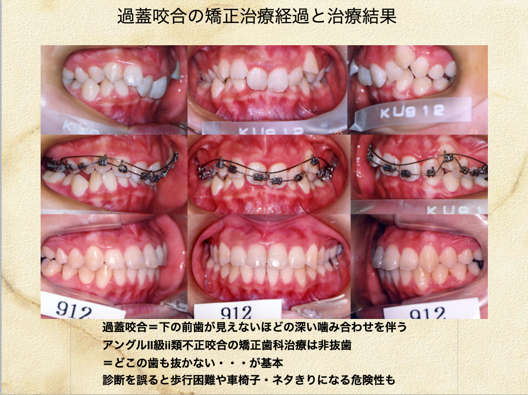 【症例2】叢生を伴う過蓋咬合 詳細