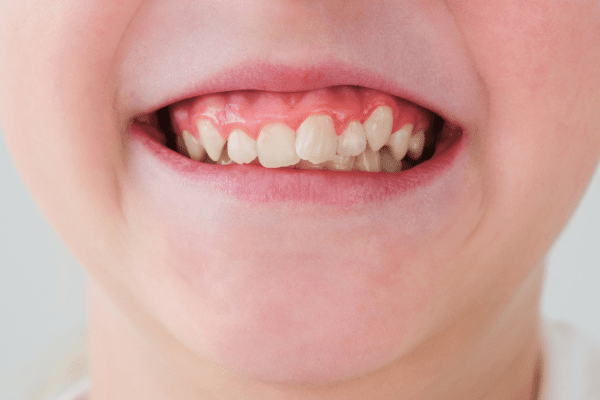 複雑に重なり合った歯並びでも対応できる