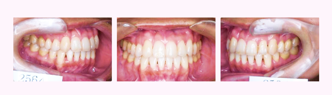 叢生の症例1のAfter