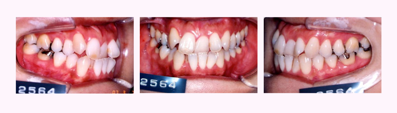 叢生の症例1のBefore