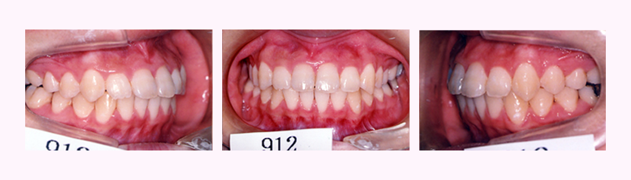 叢生の症例2のAfter