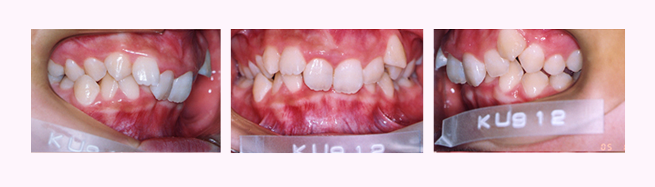 叢生の症例2のBefore