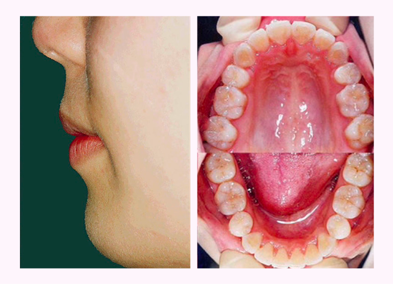 叢生の症例3のAfter