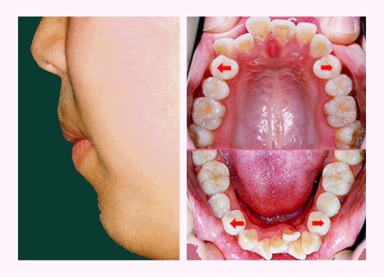 叢生の症例3のBefore