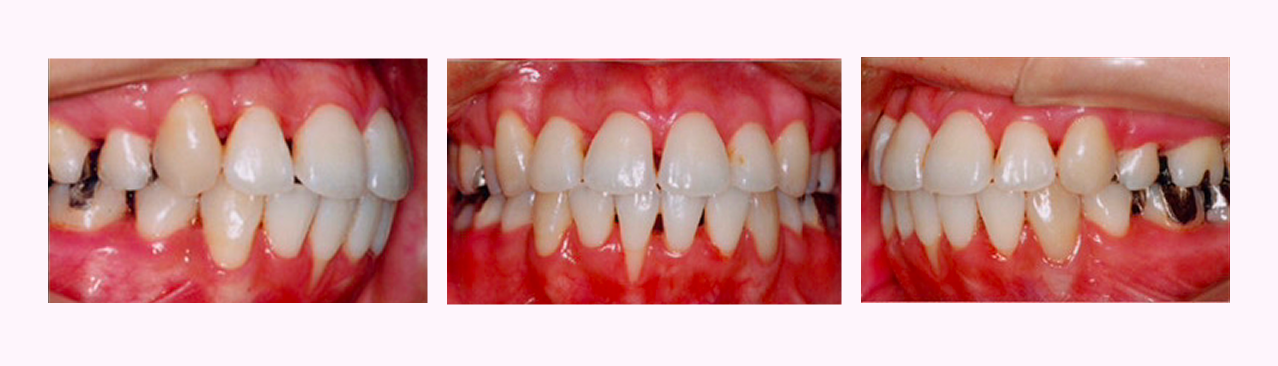 叢生の症例4のAfter