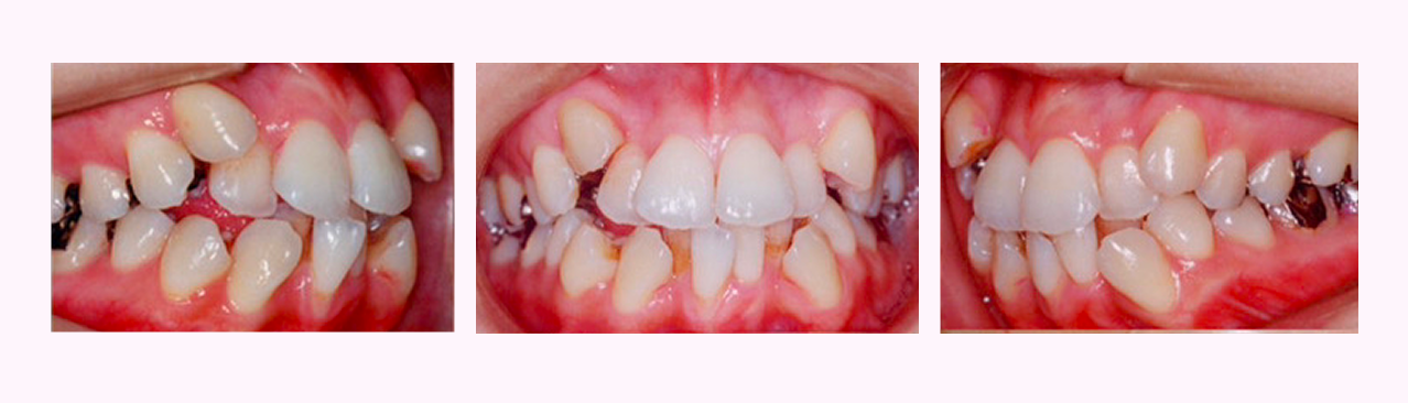 叢生の症例4のBefore