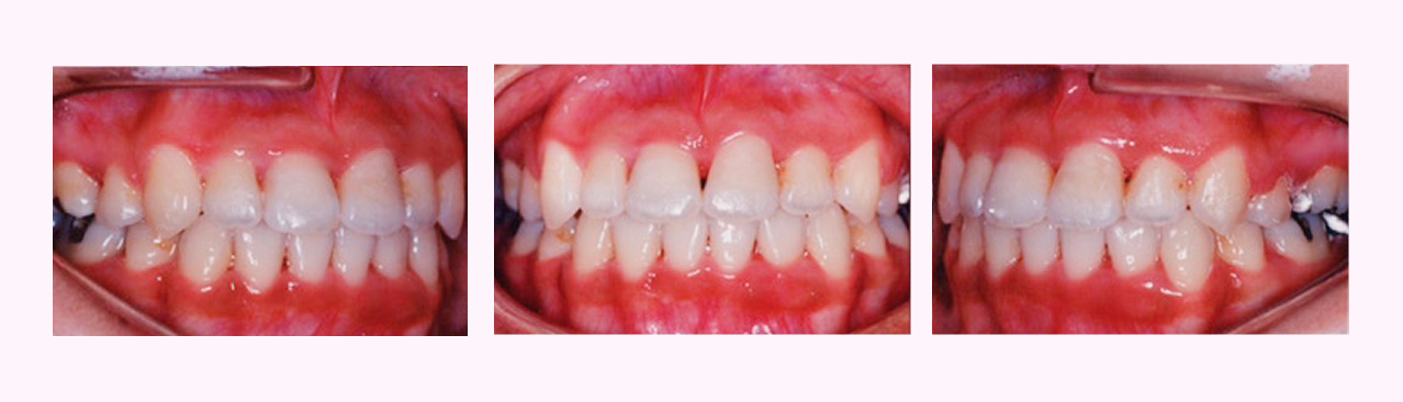 叢生の症例5のAfter