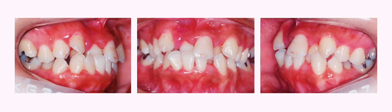 叢生の症例5のBefore