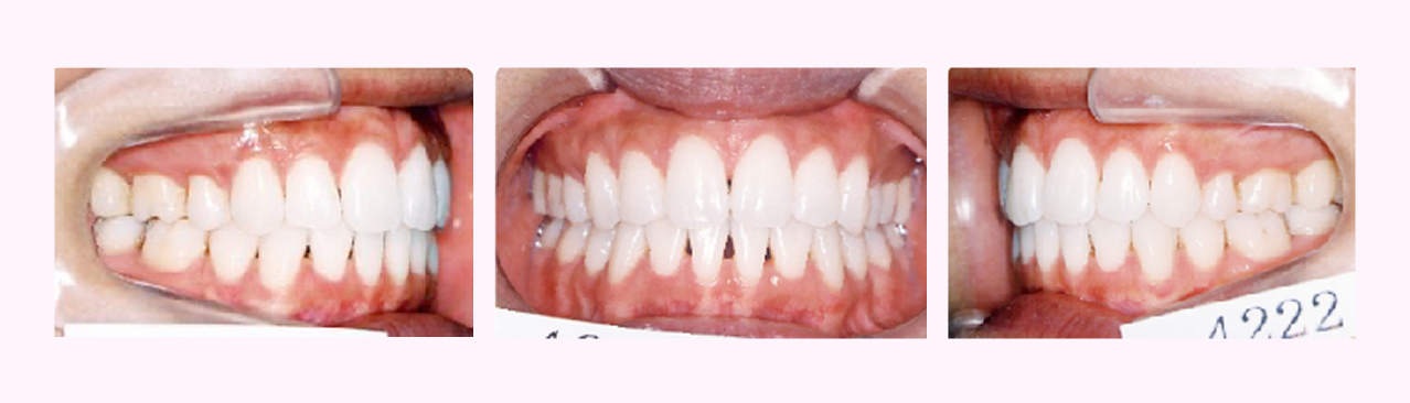 叢生の症例6のAfter