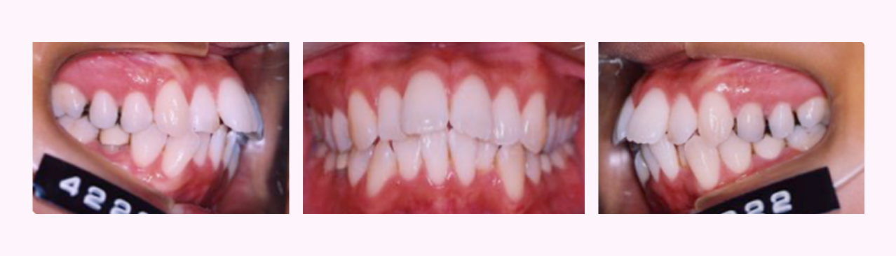 叢生の症例6のBefore