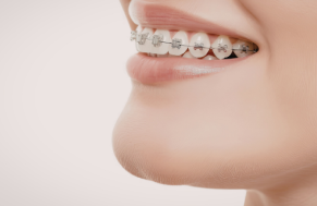 矯正治療中の口元