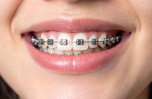 矯正器具を付けている口元