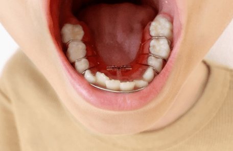 矯正器具を付けている口元