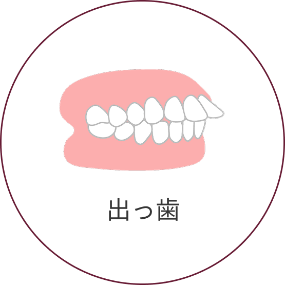 上顎前突(出っ歯)
