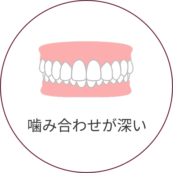 過蓋咬合（かがいこうごう）