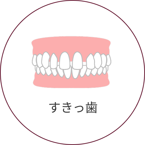 すきっ歯