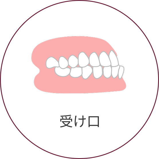 下顎前突（受け口）