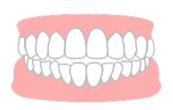 前歯が閉じない