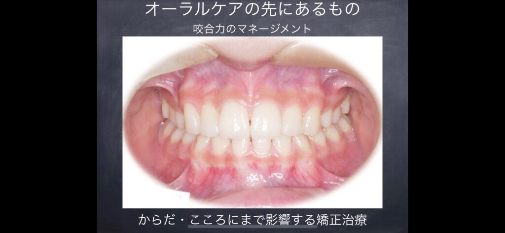 マウスピース矯正やっておりません！なぜなら・・・