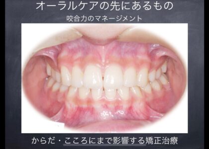 矯正歯科における咬合論