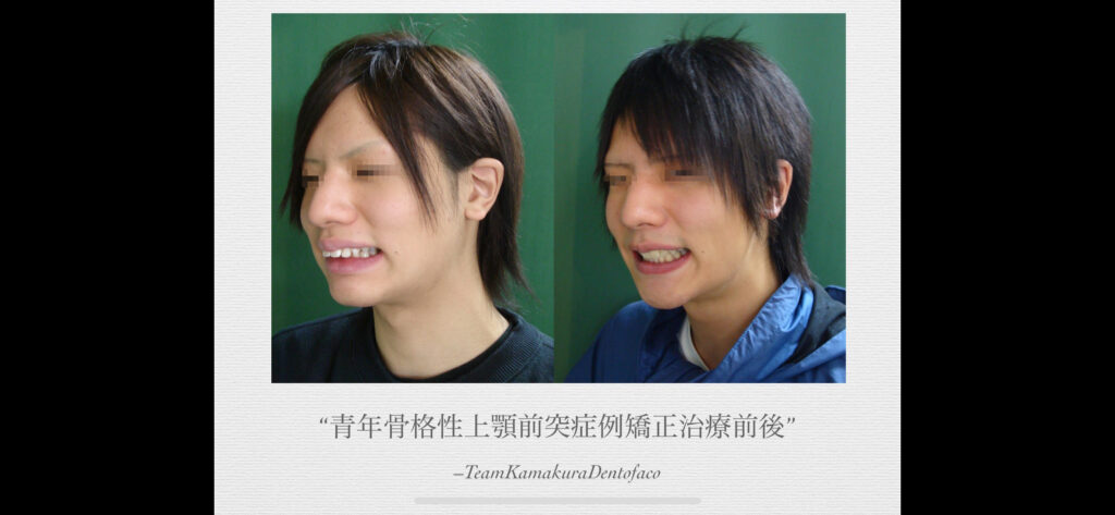 矯正歯科鎌倉 dentofacoにおける矯正・顎顔面整形歯科治療結果２）青年期男性