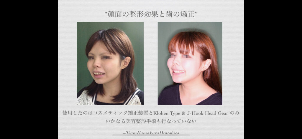 矯正歯科鎌倉 dentofacoにおける矯正・顎顔面整形歯科治療結果１）成人女性