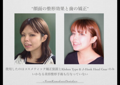 矯正歯科鎌倉 dentofacoにおける矯正・顎顔面整形歯科治療結果１）成人女性