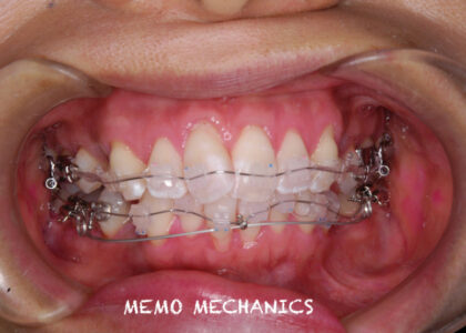 当院で矯正歯科専門医がルーティーンに行っている矯正治療＝MEMO法の紹介第2回目