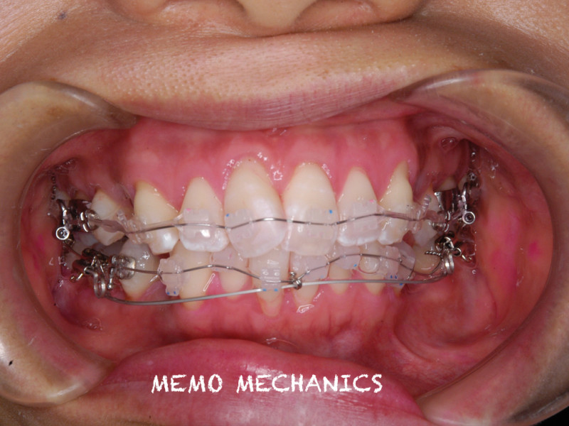 当院で矯正歯科専門医がルーティーンに行っている矯正治療＝MEMO法の紹介第2回目