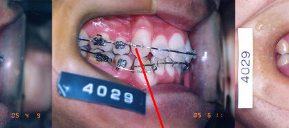 インビザラインやめたほうがいい１０の理由= 一矯正歯科専門医の意見 6) 抜歯して治した症例も見たことはあるが抜歯空隙も閉じ切れてなく不完全で長期間安定性が得られるとは思えない