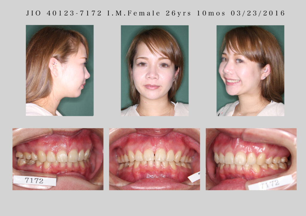 ”骨格性上顎前突不全症例２）(矯正歯科による前歯の移動と顎顔面整形歯科的顔貌の変化)”