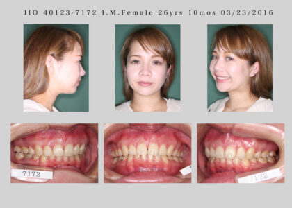 ”骨格性上顎前突不全症例２）(矯正歯科による前歯の移動と顎顔面整形歯科的顔貌の変化)”