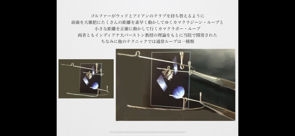 矯正歯科専門医が行うセグメンテッド・アーチ・テクニック