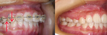 「4-1) 価値ある本当の矯正治療ですか？やり直し矯正の勧め＝社会・経済的観点から」