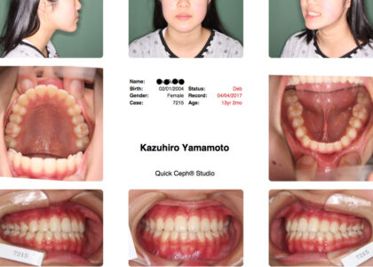 「矯正歯科における抜歯の是非-矯正治療後の安定性の確保の点から」