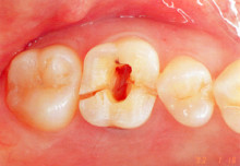 「ひとはまだ本当の矯正治療を知らない！＝矯正歯科鎌倉 dentofacoで矯正歯科専門医による価値ある本当の矯正治療で改善可能な点　４）−２） 噛む力のメンテナンスの観点から」