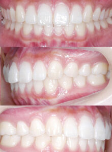 「ひとはまだ本当の矯正治療を知らない！＝矯正歯科鎌倉 dentofacoで矯正歯科専門医による価値ある本当の矯正治療で改善可能な点2)噛み合わせがよくなる＝機能的意義」