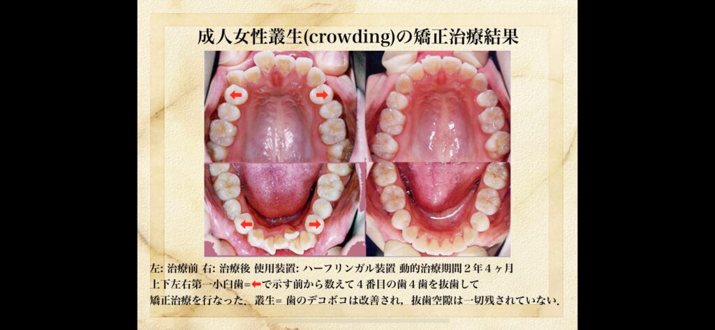 「抜歯？　非抜歯？・・・」