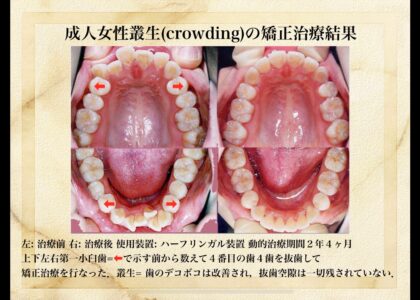 「抜歯？　非抜歯？・・・」